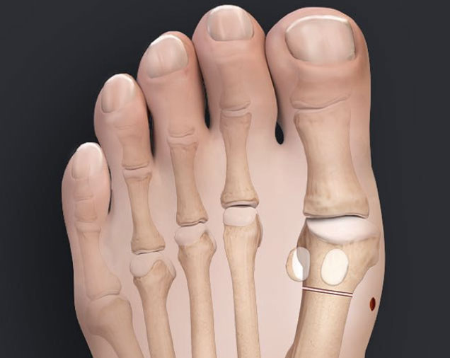 Bunion Surgery with the Arthrex System