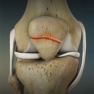 Knee-Fracture