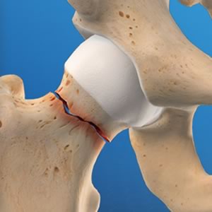 Could You Have a Hip Fracture and Not Know It?: Tuscaloosa Orthopedic &  Joint Institute: Orthopedic Surgeons