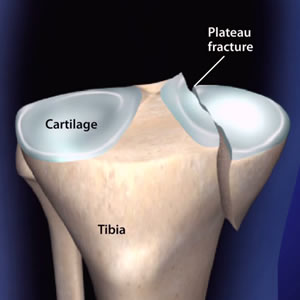 conditions Knee Fracture