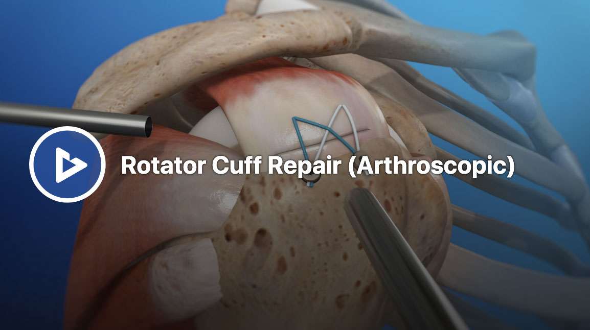 Arthroscopic Rotator Cuff Repair