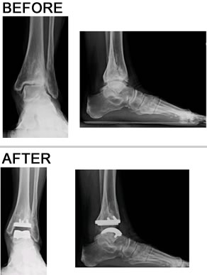 X-rays of Debbie Mullady's ankle before and one year after replacement surgery by Dr. Randolph Sealey of Danbury Orthopedics.