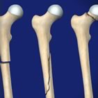 Hip and Thigh Conditions